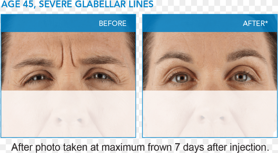 Xeomin Results 45u Dysport In Glabella, Art, Sad, Collage, Face Png Image